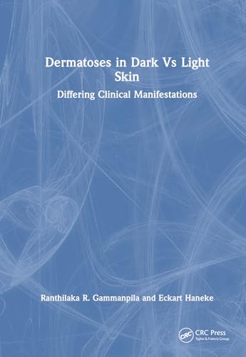 Dermatoses in Dark Vs Light Skin – Book Cover