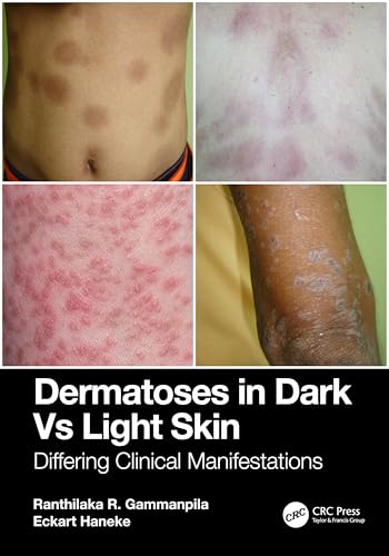 Dermatoses in Dark Vs Light Skin – Book Cover